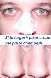 Perdorni paste dhembesh dhe thuaju lamtumire pikave te zeza ne fytyre